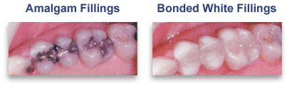 amalgam and white fillings